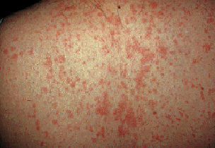 How Long Does Measles Last?