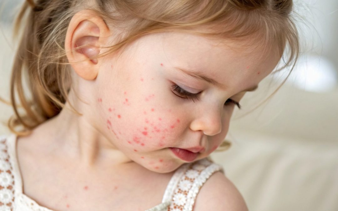 What Should I Do If I Think My Child Has Measles?